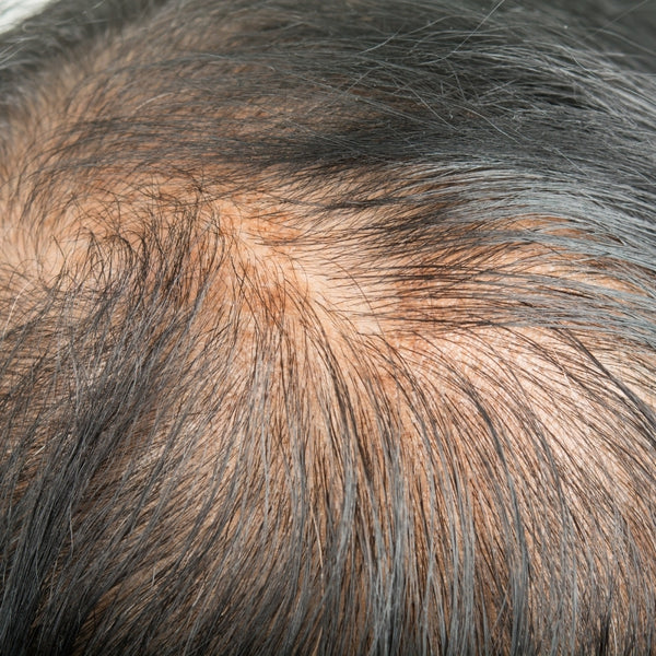 hair thinning on men's head
